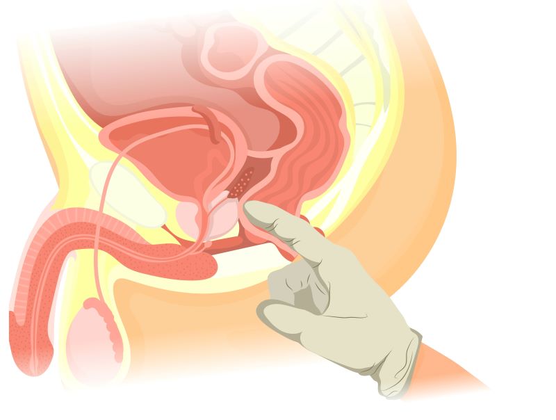 Gloved finger touching prostate in anus